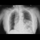 Left diaphraghmatic hernia: X-ray - Plain radiograph